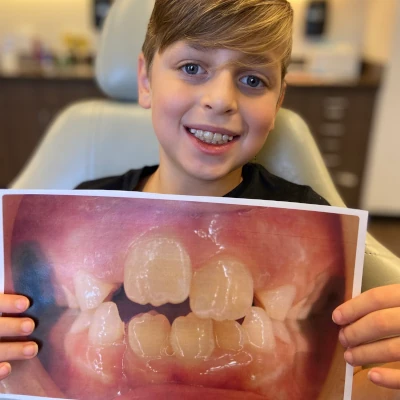 Kids Braces Before & After 2